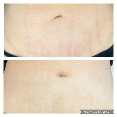 Before and after inkless stretch mark treatment