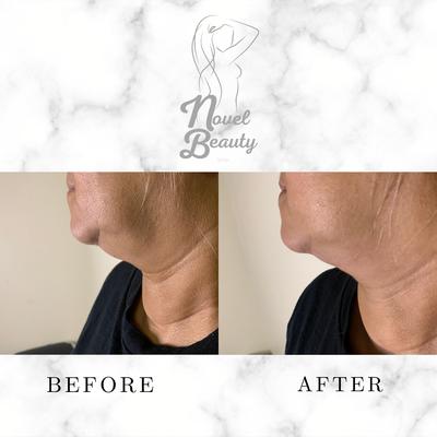 1 session of Radio Frequency and Laser Lipo