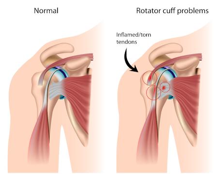 shoulder pain/ frozen shoulder