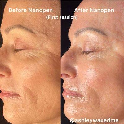 Nanopen Facial