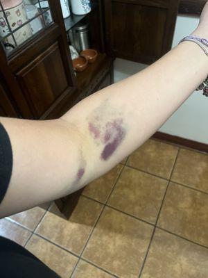 Don't come here unless you want this to happen to your arm