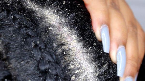 Are you having Issues with your Scalp. Schedule a scalp detox treatment.