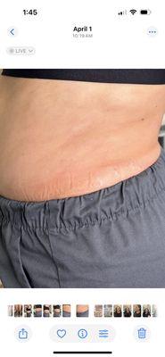 after lymphatic therapy