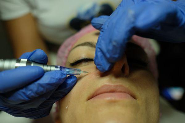 Microneedling