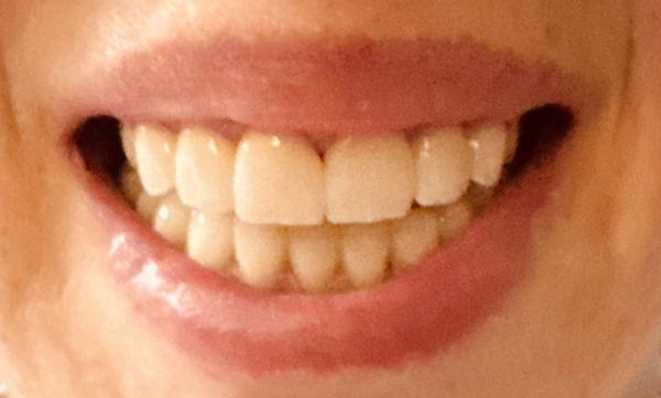 My new porcelain veneers