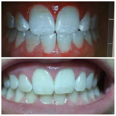 May 2016 - July 2016. Teeth bleaching + resurfacing to remove calcification, no bonding. 7/14/16