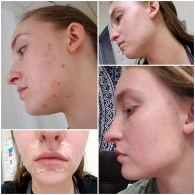 Chemical peels do wonders