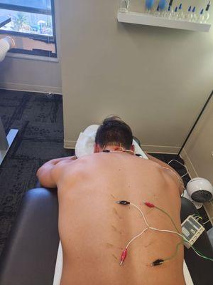 Dry-needling