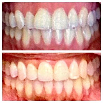 Invisalign before and after