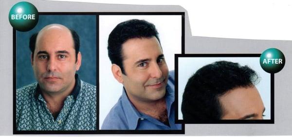 Hair loss therapy Tampa