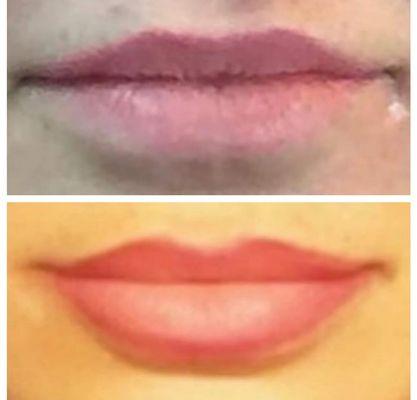 Lip Augmentation @ The Face Place