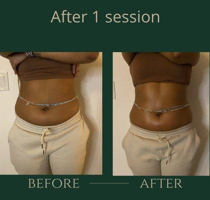 2-3 inches down after one ultrasound cavitation treatment