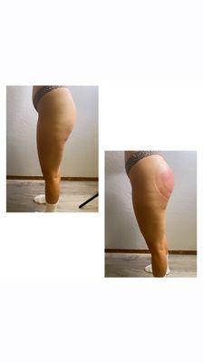 Book Butt Enhancement!
Client details: 1 session
For lasting results you need a 4-8 sessions.