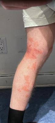 Before Sonafine Wound Dressing cream