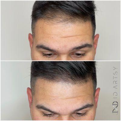 Scalp Micropigmentation