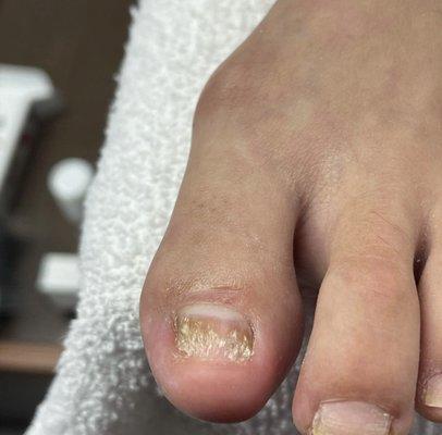 Specialized Pedicure with toenail reconstruction with NANOFLEX. BEFORE!