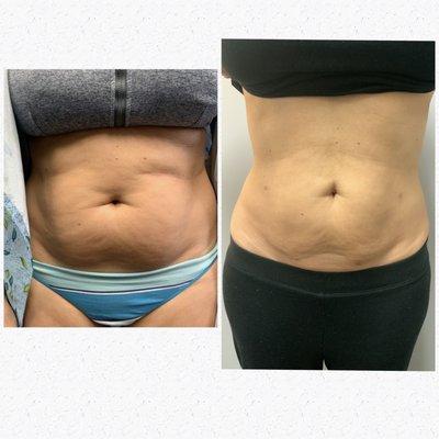 Bodytite with Morpheus8
4 month results