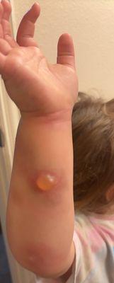 Later that evening after 2 hours on anti biotics