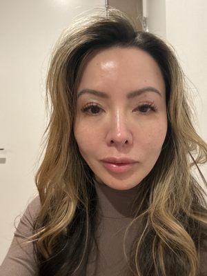 Almost Clear skin no make up no filter . I struggle with pigment , acne and redness.