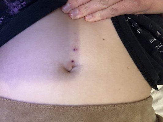 After I took the piercing out.