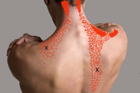 Shoulder and neck pain is often caused by trigger points