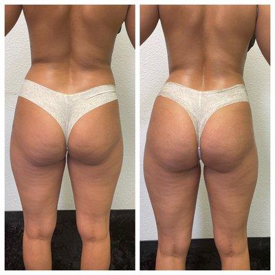 Butt vaccum therapy. Cellulite has decreased and buttt has lifted and plumped.