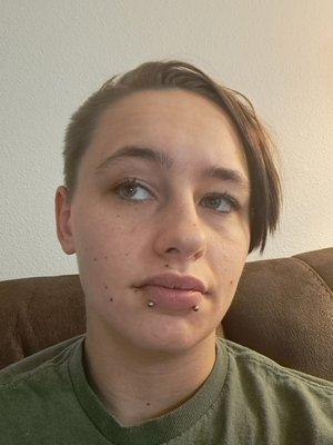 A photo of me with fresh snake bites, lip still swollen.