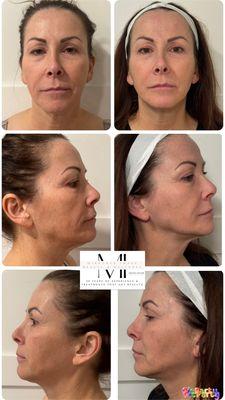 Lift, Tighten & Smooth w/ 0 downtime & great results!!!! Artemis T-Shape 2, Exclusively at Mirrored Image Beauty & Wellness!