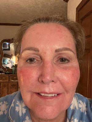 Prior to the laser treatment About week 3.5 with ZO