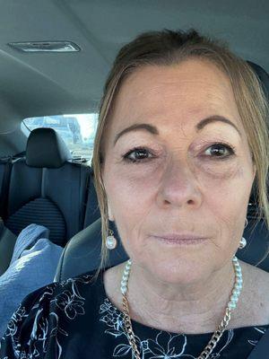 8-13-25 Post PRP done on 8-10-25