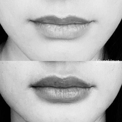 Lip filler: above picture is before, below picture is after 1 syringe of filler.
May last up to 9-12 months