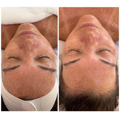 Microdermabrasion