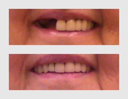 "Invisible" Partial Denture