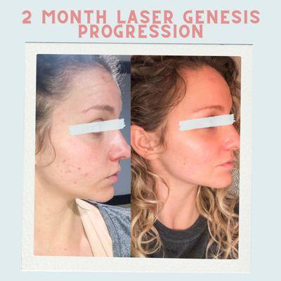 A non-invasive and comfortable laser procedure is used to fade scarring, redness, broken blood vessels, and improve the look of rosacea!