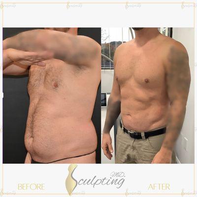 Awake Lipo ABs Etching