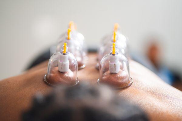 Cupping can help reduce pain and increase blood flow