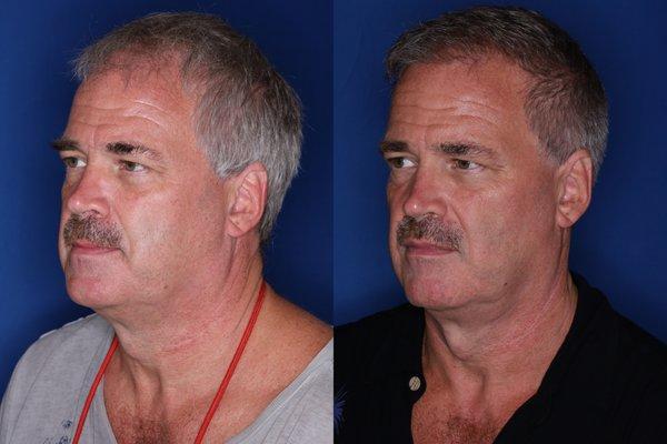 Kalos Hair Transplant LLC