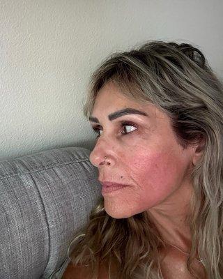 The microneedling process