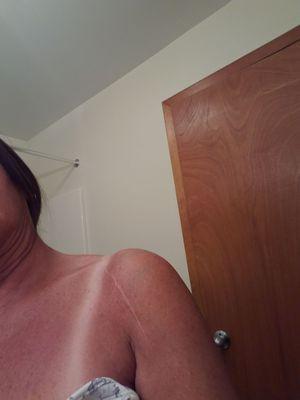 This is the left shoulder replacement done correctly by a different doctor. I have full use and no complaints