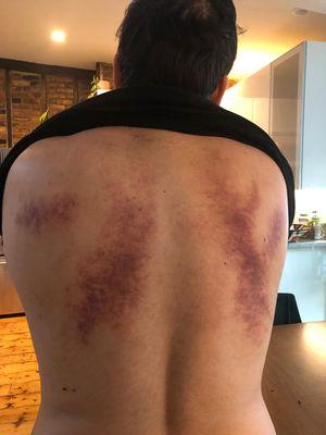 What the masseuse did to my back