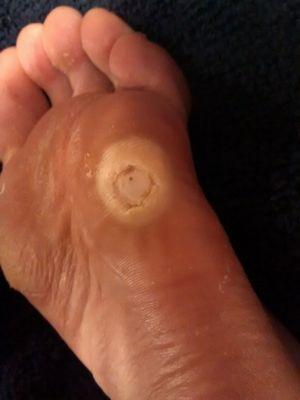 Healthy skin and tissue cut out with a scalpel.
