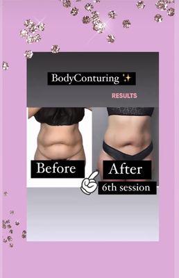 BodyConturing treatment
