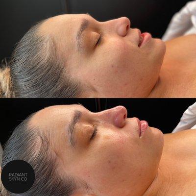 Before and after Ultimate facial
