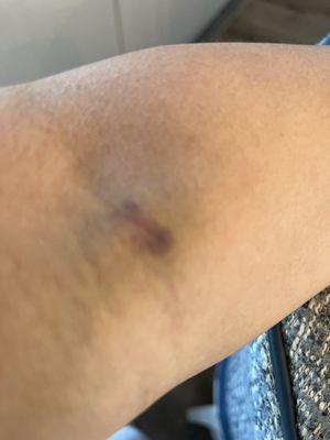 Bruise and swelling