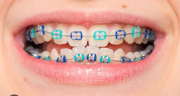 Braces For Beautiful Faces