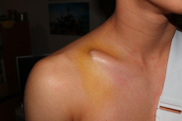 My sons destroyed  clavicle bone.