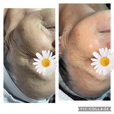 Lift and sculpt facial with pro power eye peel.