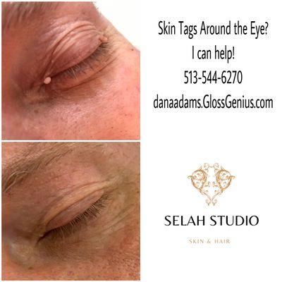 Skin tag treatments are effective and safe. Skin Classic uses high frequency technology to dehydrate skin tags which fall off on their own.