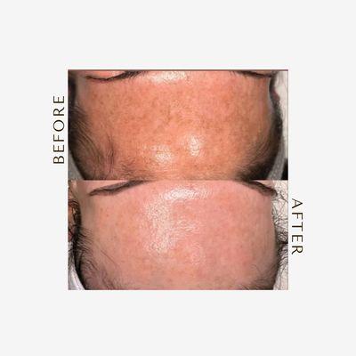 Microneedling duo: brighter, more even skin after 2 sessions. Clean products, gentle care, real results.