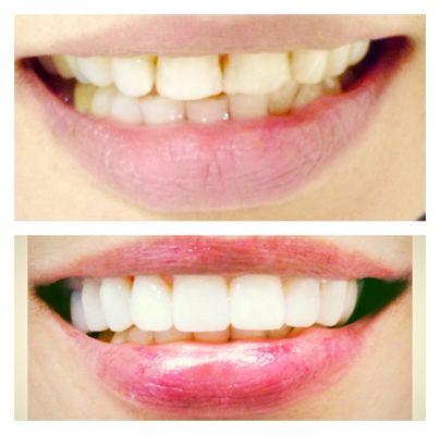 Smile makeover with porcelain veneers by cosmetic dentist , Dr. Miriam Kerman